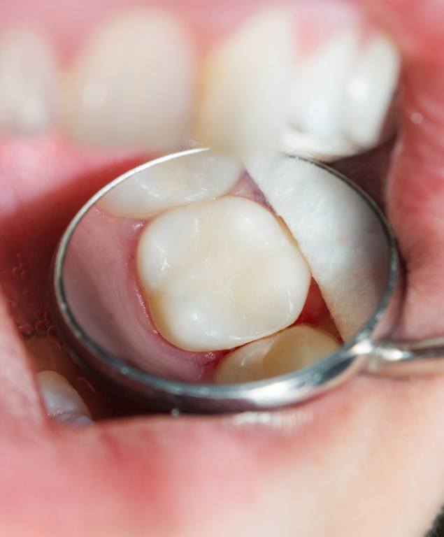 Close up of dental mirror showing tooth with white composite filling in Cambridge