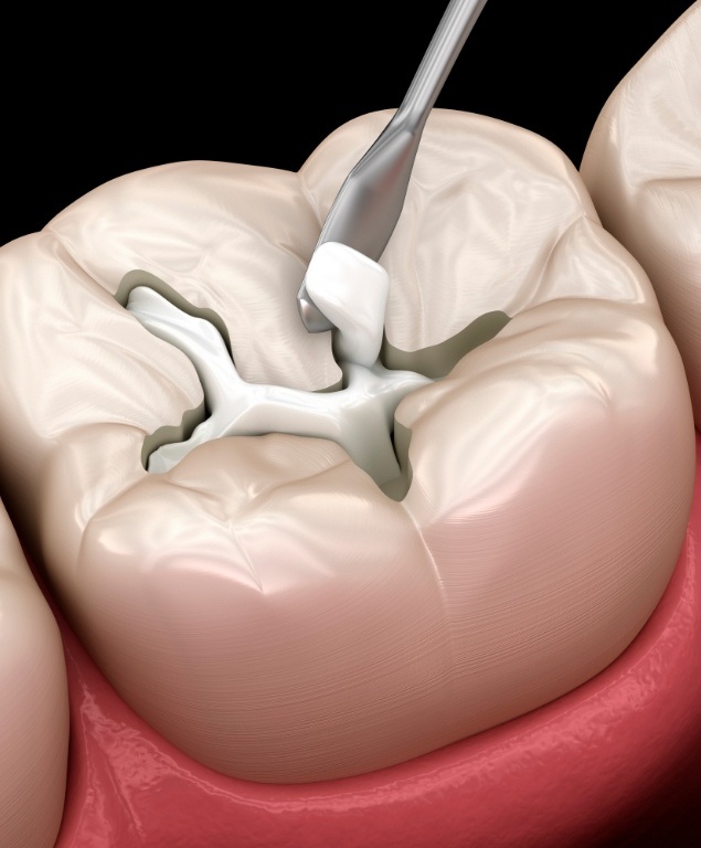 Illustrated composite filling being placed onto a tooth